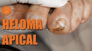 Heloma apical  1er video podologiaintegral asmr [upl. by Annaierb121]