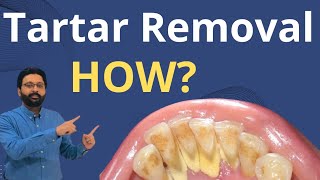 Tartar Removal from Teeth  Dental Teeth Cleaning [upl. by Esirec304]