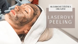 Tajemství celebrit pro bezchybnou pleť Laserový peeling Carbon Peel [upl. by Alliw]