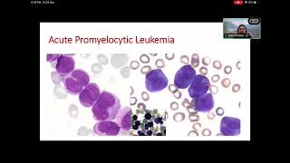 MOLECULAR DIAGNOSIS OF CANCER HEMATOPATHOLOGY [upl. by Hayman]