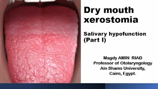 Dry mouth xerostomia Salivary hypofunction Part I [upl. by Onairotciv]