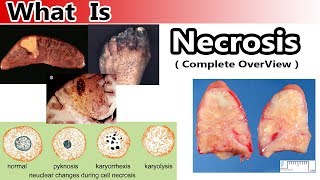 What is Necrosis  Complete Overview [upl. by Ateekan]