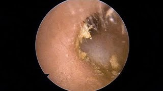 Milia Removal The first person to clean earwax after 35 years of life 02 [upl. by Jaimie]