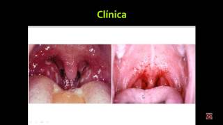 Faringoamigdalitis Agentes infecciosos Dx diferencial Viralbacteriana Tratamiento Infectología [upl. by Blader]