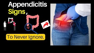 What are top signs of Appendicitis [upl. by Lletnahs]