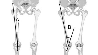 Precise measurement of knee Qangle angle kneepainrelief kneepain quadriceps knee alignment [upl. by Abner]