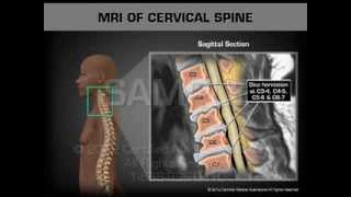 MRI of Cervical Spine [upl. by Gies]