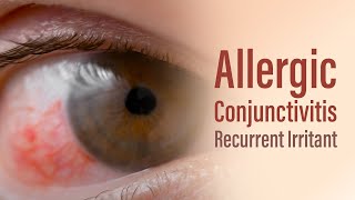 Allergic conjunctivitis [upl. by Crabb]