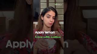 DIY Remedy For Dandruff How to Use Lemon For Dandruff Treatment at Home [upl. by Ailefo]