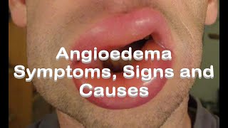 Angioedema  Symptoms Signs and Causes [upl. by Bette-Ann548]