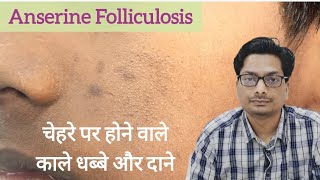 चेहरे पर होने वाले काले धब्बे और दाने  Anserine Folliculosis Keratosis Pilaris Black Spots on Face [upl. by Lanta853]