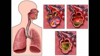 BRONQUITIS CAUSAS SÍNTOMAS Y TRATAMIENTO BRONQUIOLITIS TRATAMIENTO PARA BRONQUITIS NEBULIZACIÓN [upl. by Judon]