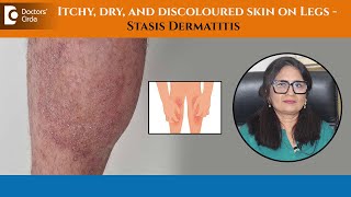 How to Treat Leg Discolouration due to Stasis Dermatitis or EczemaDrAruna PrasadDoctors Circle [upl. by Llevad]