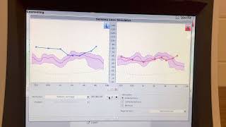 Hearing loss simulation [upl. by Pallua]