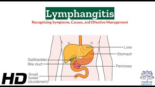 Lymphangitis 101 A Comprehensive Guide to Symptoms and Effects [upl. by Vinia]