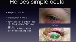 herpes simple ocular [upl. by Ramiah]