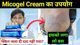 Micogel cream uses in hindi – दाद का परमानेंट इलाज  micogel cream  miconazole nitrate cream ip [upl. by Eniron]