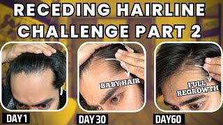 30 days HAIRLINE REGROWTH challenge PART 2  सिर्फ 1 महीने मैं RECEDING HAIRLINE REGROW करो [upl. by Coh973]