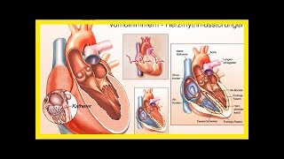 Herzrhythmusstörungen Neue heilende Therapie gegen Vorhofflimmern [upl. by Amati430]