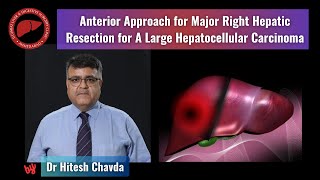 The anterior approach for right hepatectomy for a large hepatocellular carcinoma  Dr Hitesh Chavda [upl. by Rhody]