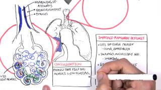 PART I  Pneumonia Overview Lobar and Bronchopneumonia [upl. by Charles]