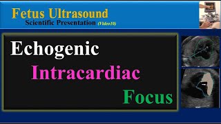 Fetal Echogenic Intracardiac Focus Ultrasound [upl. by Aklim634]