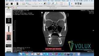 Volux  Tutorial OsiriX Lite parte 1 di 2 [upl. by Marl]