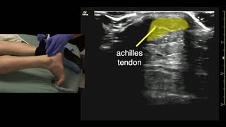 Ultrasound of the Achilles Tendon [upl. by Ikkela890]