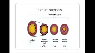 Intimal Hyperplasia Dr Venkatesh [upl. by Selimah]