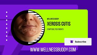 Xerosis Cutis Severe Dry Skin Calluses and Fissures [upl. by Drofnats]