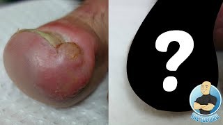 Before amp After Did It Heal INFECTED INGROWN TOENAIL REMOVAL FOLLOWUP [upl. by Odlanor]