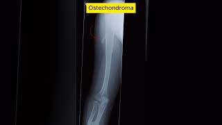 Osteochondroma radiological [upl. by Nitsew12]