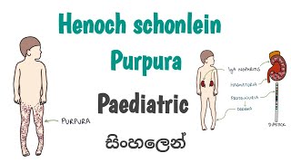 Henoch schonlein purpura  HSP  සිංහලෙන් [upl. by Gile686]