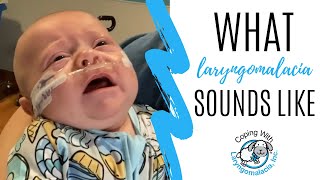 What Laryngomalacia Sounds Like  noisy breathing  newborn congestion [upl. by Venditti123]