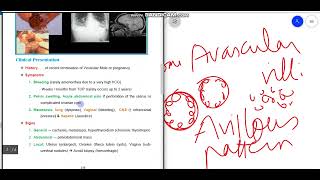 د السكري choriocarcinoma [upl. by Wiley]