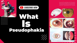 What is pseudophakiasign of pseudophakia symptoms of pseudophakia psedophekic eye ophthalmic [upl. by Christen]