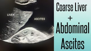 Coarse Liver amp Abdominal Ascites on Ultrasound  Chronic Liver Disease  Liver Cirrhosis [upl. by Nylimaj868]