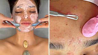 ACNE NO Talking SPAASMR Facial Pimple Popping [upl. by Ruthven]