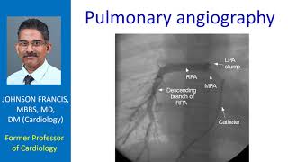 Pulmonary angiography [upl. by Anoik]