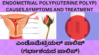 ENDOMETRIAL POLYPUTERUS POLYP CAUSES SYMPTOMS TREATMENT IN KANNADAINFERTILITY ENDOMETRIAL POLYP [upl. by Thibaut]