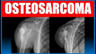 Osteosarcoma radiology xray doctor [upl. by Waverly]