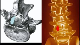 Behandlung der Spinalkanalstenose [upl. by Ylekalb991]