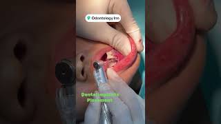 DENTAL IMPLANT INSERTION INTO BONE BY DENTAL IMPLANT SPECIALIST DR MUHAMMAD AHMAD [upl. by Bigner]