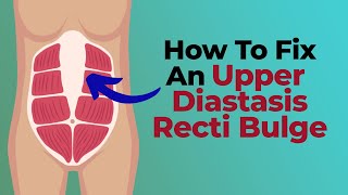 Flatten Upper Abdominal Bulging Upper Diastasis Recti Bulge [upl. by Norag]