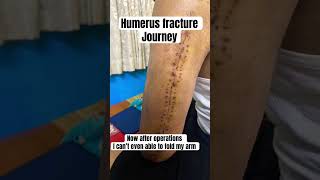 Humerus fracture journey motivation physiotherapy rehabilitation [upl. by Cyril]