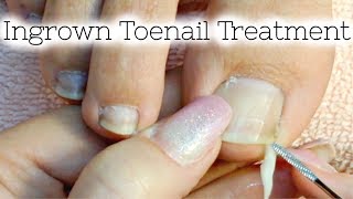 Sore Toenails Is it Impacted or Ingrown [upl. by Fletch]