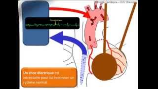 Principe de la circulation extracorporelle  CEC [upl. by Aiynat]