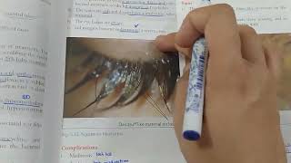 Blepharitis  anterior  posterior  EYELIDS LECTURE 3 JATOI [upl. by Burrell]