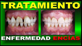 FASE I Y II DEL TRATAMIENTO DE LA ENFERMEDAD PERIODONTAL [upl. by Abe]