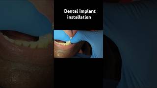 All on 4 implantdentist dentalclinic teeth tooth ytshorts insiderscraft [upl. by Nednerb]